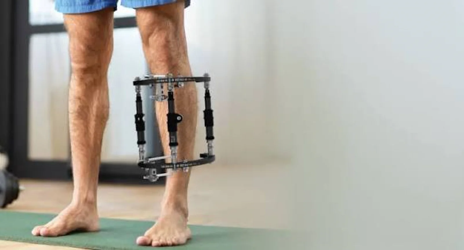 External Fixation Banner