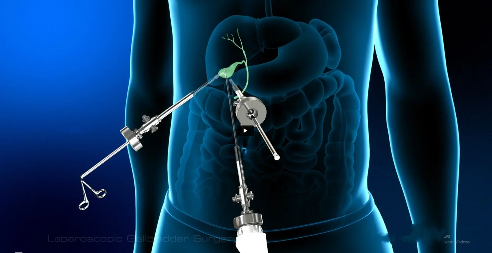 Gallbladder Stone Removal Surgery Banner