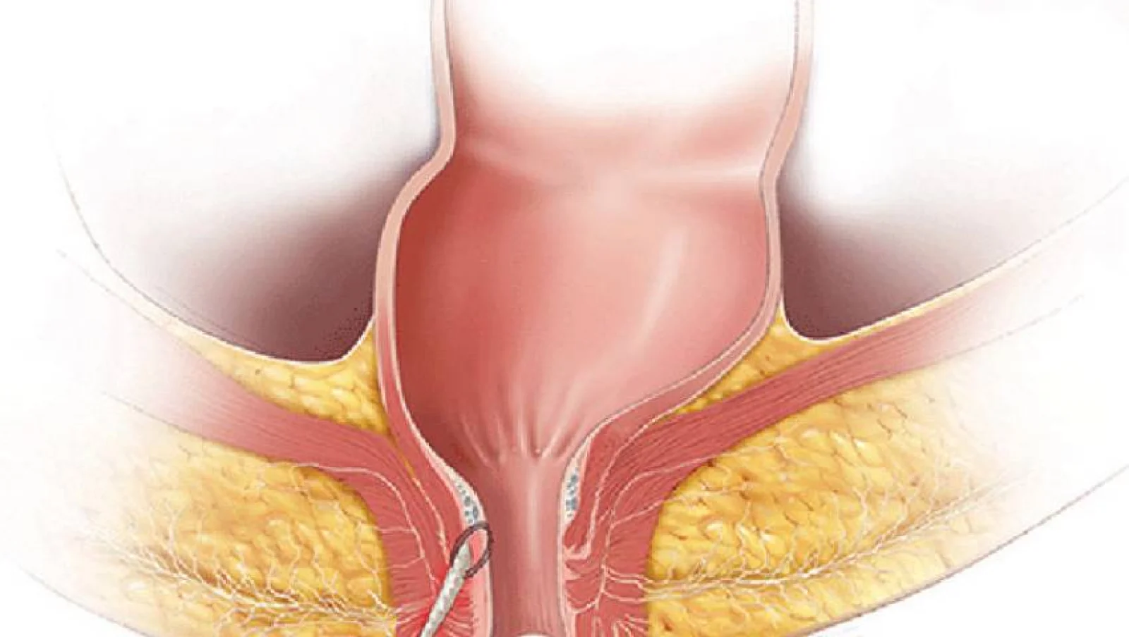 Fistula Surgery Banner