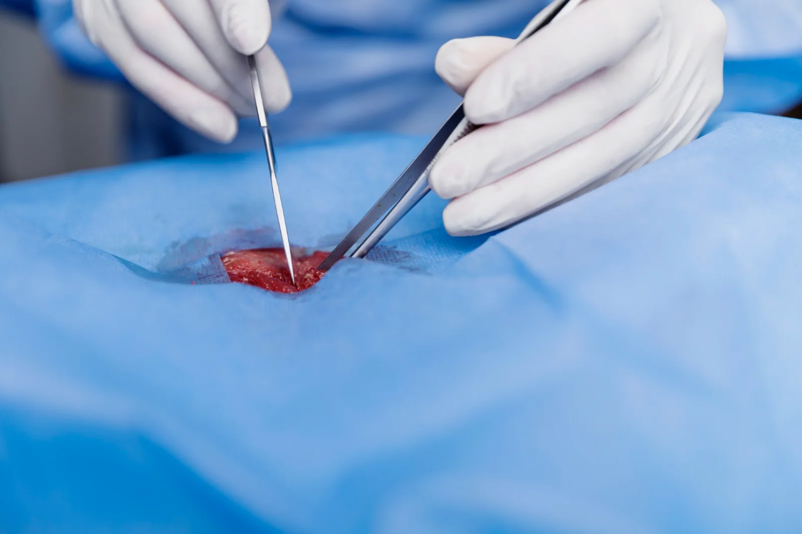 Endoscopic Polypectomy Banner