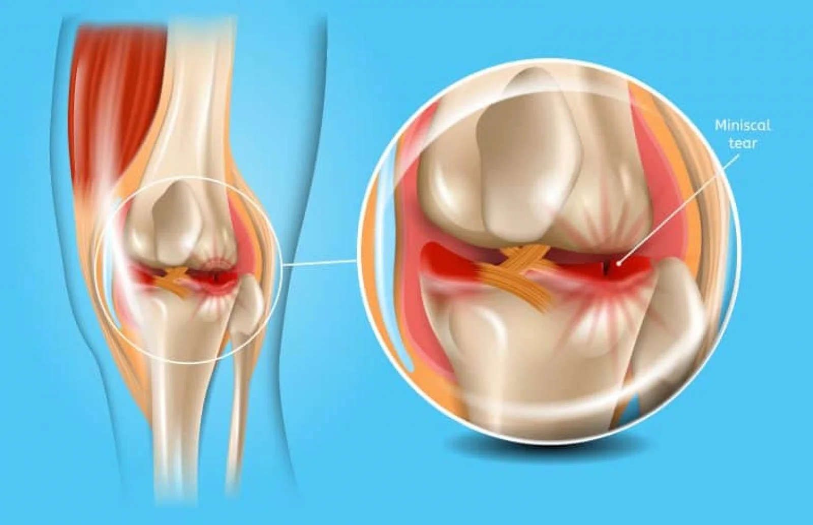 Meniscus Repair / Resection Banner