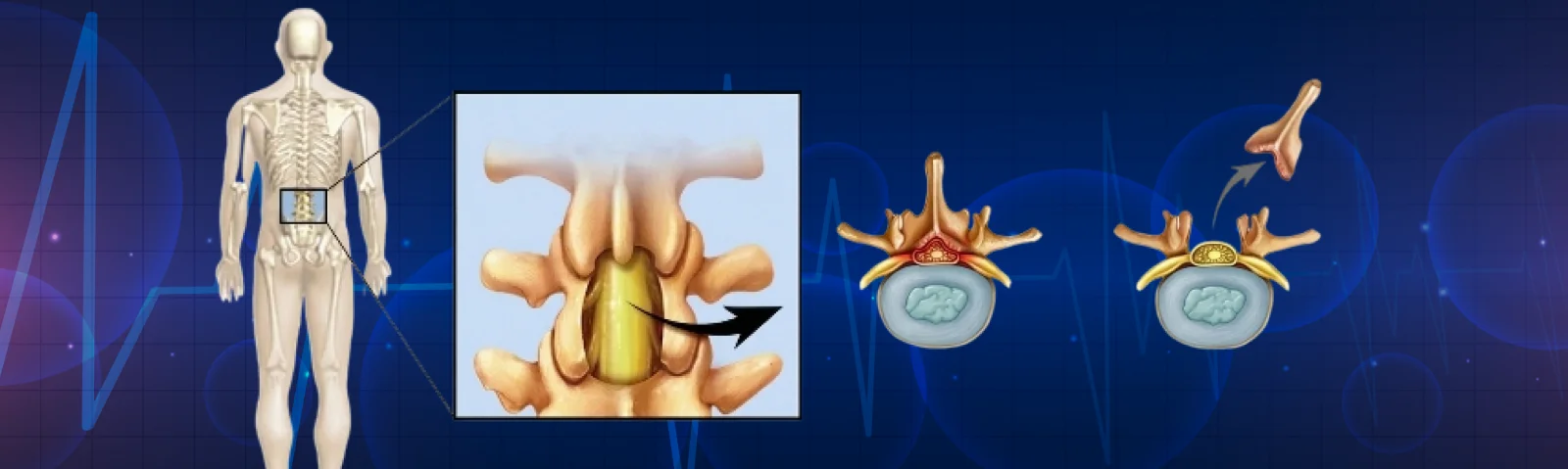 Laminectomy Banner