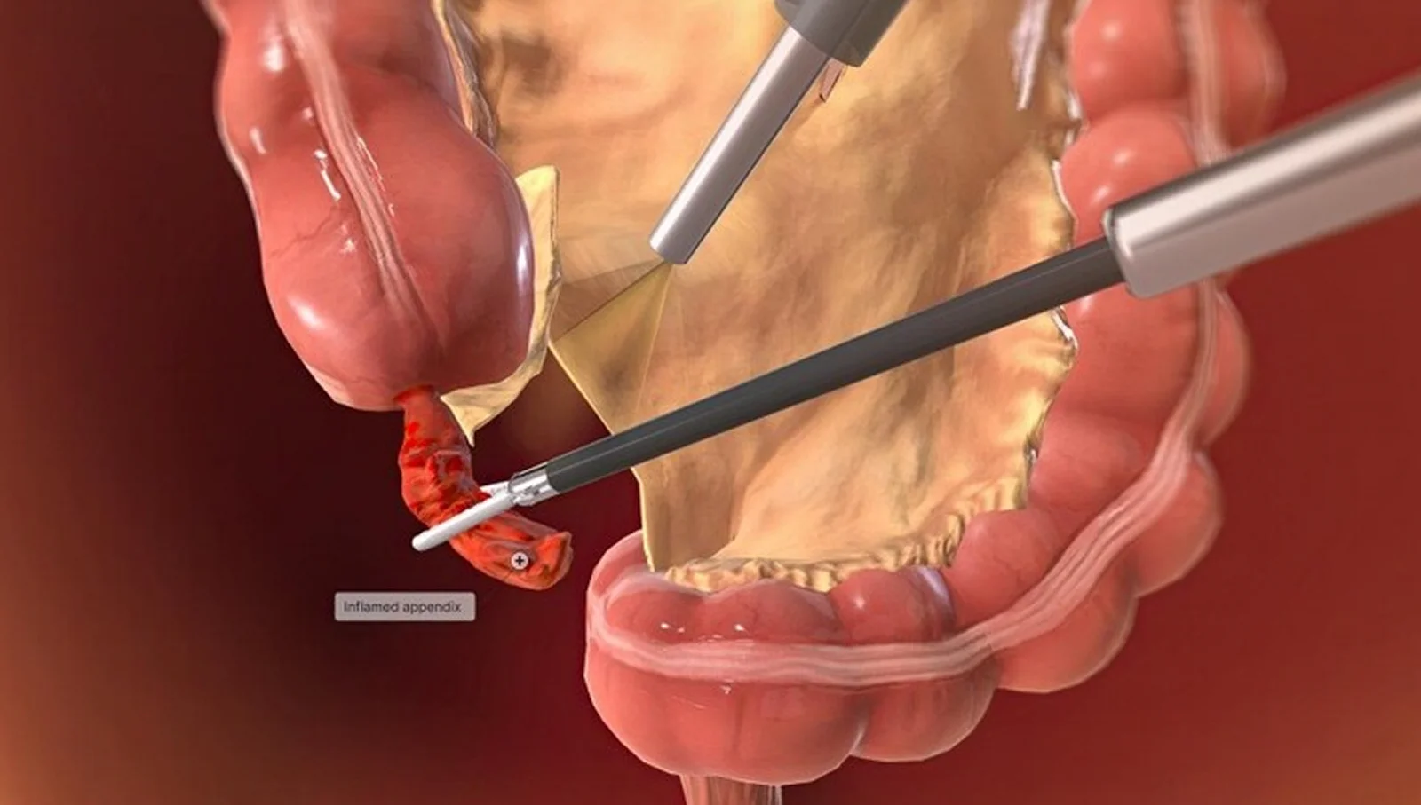 Laparoscopic Appendix Surgery Banner